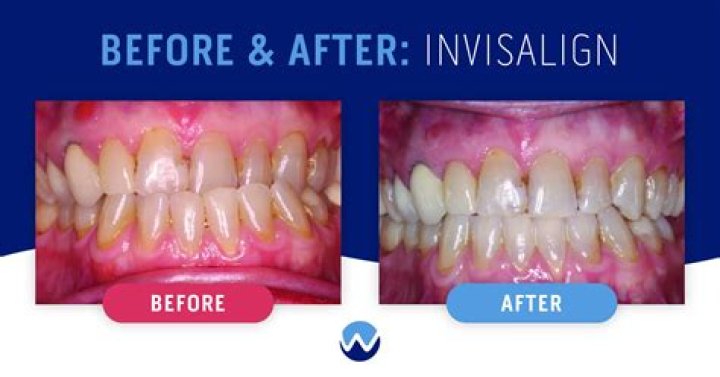 Post Malone Teeth Before And After: What Does He Have On His Teeth?